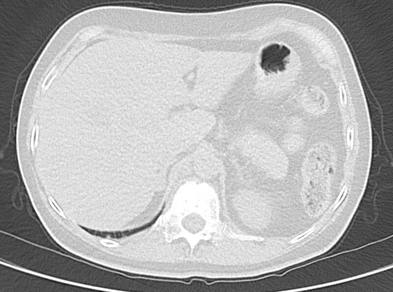 File:Adenosquamous lung carcinoma (Radiopaedia 22035-22030 lung window 58).jpg