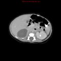 Adrenal hemorrhage (Radiopaedia 9390-10077 Axial C+ portal venous phase 9).jpg