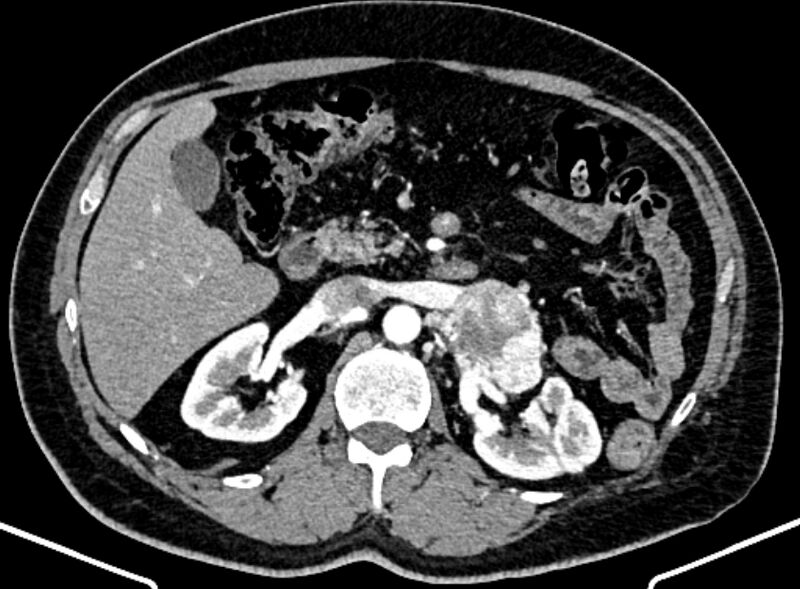 File:Adrenal metastases (Radiopaedia 73082-83791 Axial C+ arterial phase 67).jpg