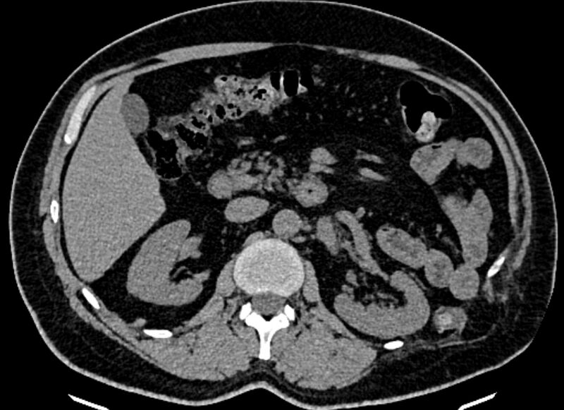 File:Adrenal metastases (Radiopaedia 73082-83791 Axial non-contrast 74).jpg