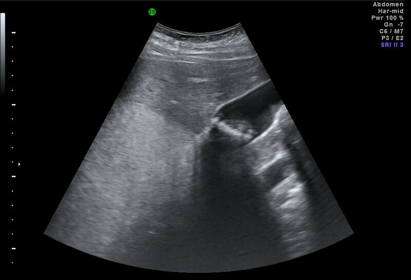 File:Adrenal myelolipoma - bilateral (Radiopaedia 74805-85811 Abdominal ultrasound 7).jpg