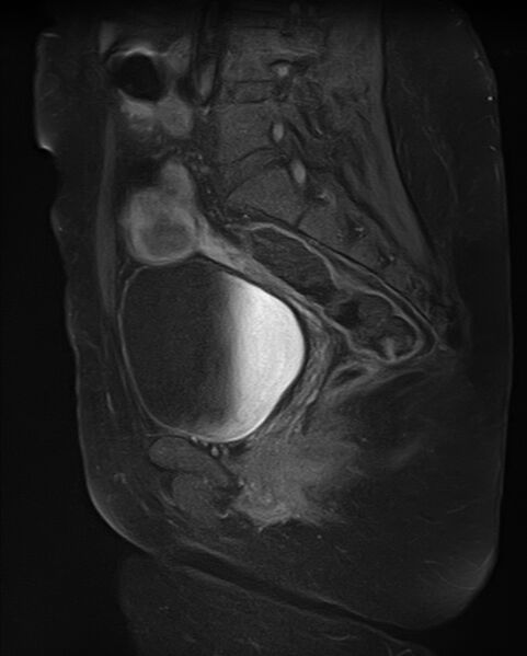 File:Adult granulosa cell tumor of the ovary (Radiopaedia 71581-81950 Sagittal T1 C+ fat sat 10).jpg