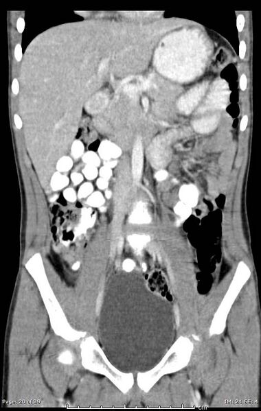File:Agenesis of the gallbladder (Radiopaedia 55454-61905 A 20).jpg