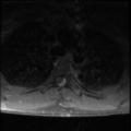 Aggressive vertebral hemangioma (Radiopaedia 39937-42404 Axial T1 C+ fat sat 30).png