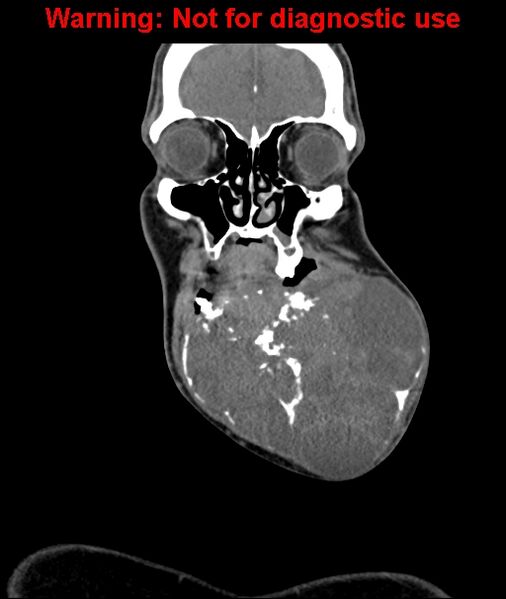 File:Ameloblastoma (Radiopaedia 33126-34164 D 19).jpg