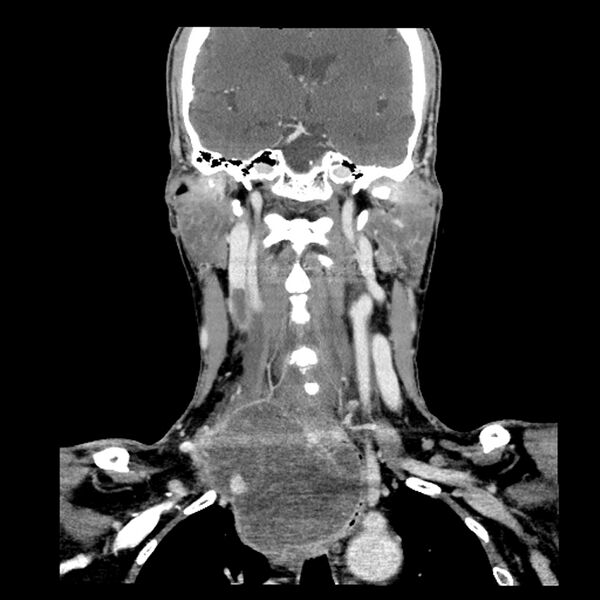 File:Anaplastic thyroid carcinoma (Radiopaedia 79087-92034 A 68).jpg