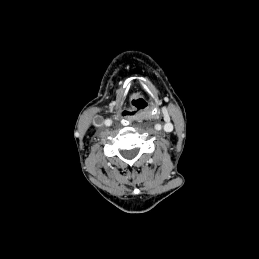 Anaplastic thyroid carcinoma (Radiopaedia 79087-92034 B 66).jpg