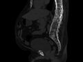 Ankylosing spondylitis (Radiopaedia 44609-48357 Sagittal bone window 51).jpg