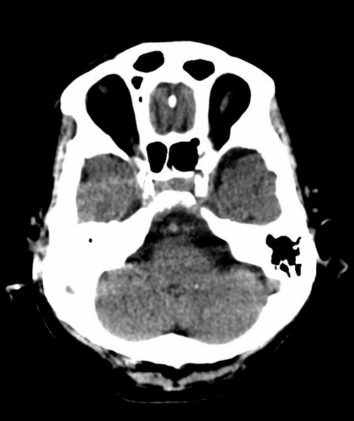 File:Anomalous intracranial venous drainage (Radiopaedia 28161-28418 Axial 47).png