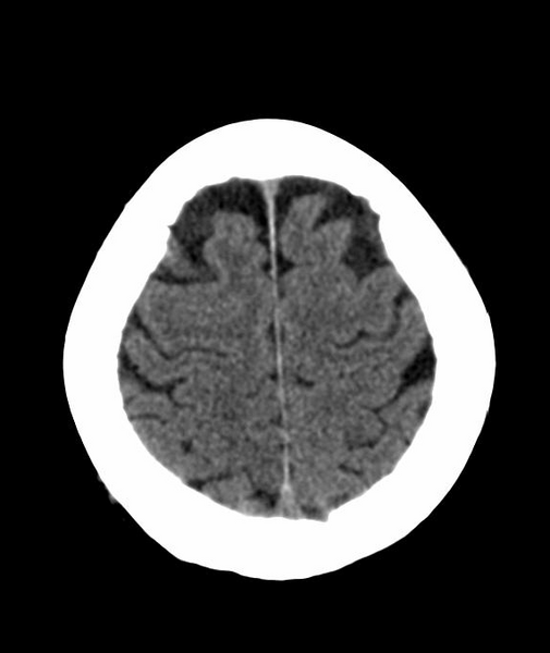 File:Anomalous intracranial venous drainage (Radiopaedia 28161-28418 Axial 48).png