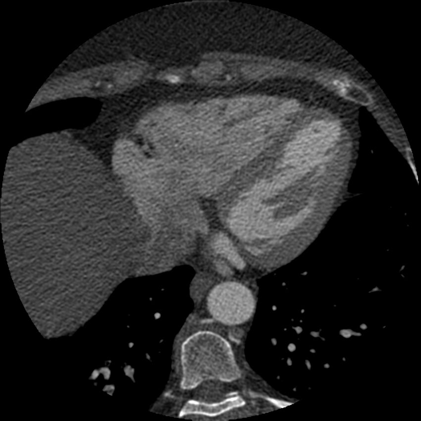 Anomalous origin of left circumflex artery from right coronary sinus (Radiopaedia 72563-83117 B 132).jpg