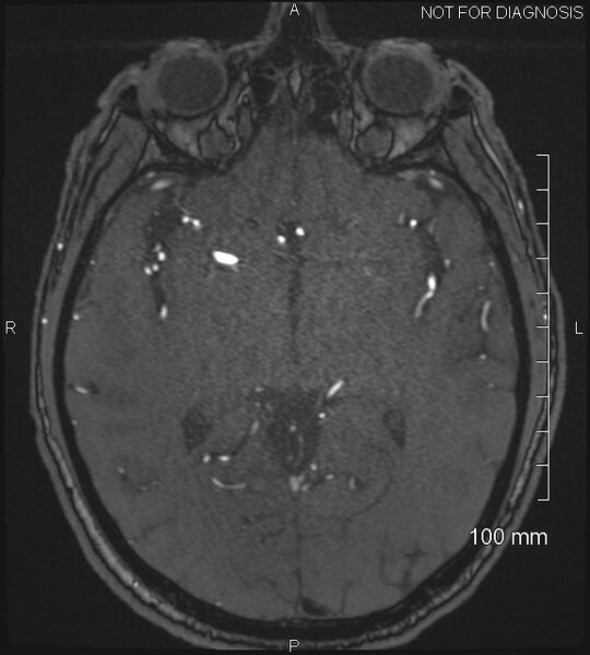 File:Anterior cerebral artery aneurysm (Radiopaedia 80683-94127 Axial MRA 112).jpg