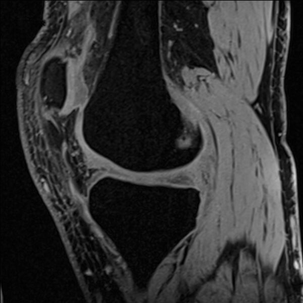 File:Anterior cruciate ligament tear - ramp lesion (Radiopaedia 71883-82322 Sagittal T1 vibe 90).jpg