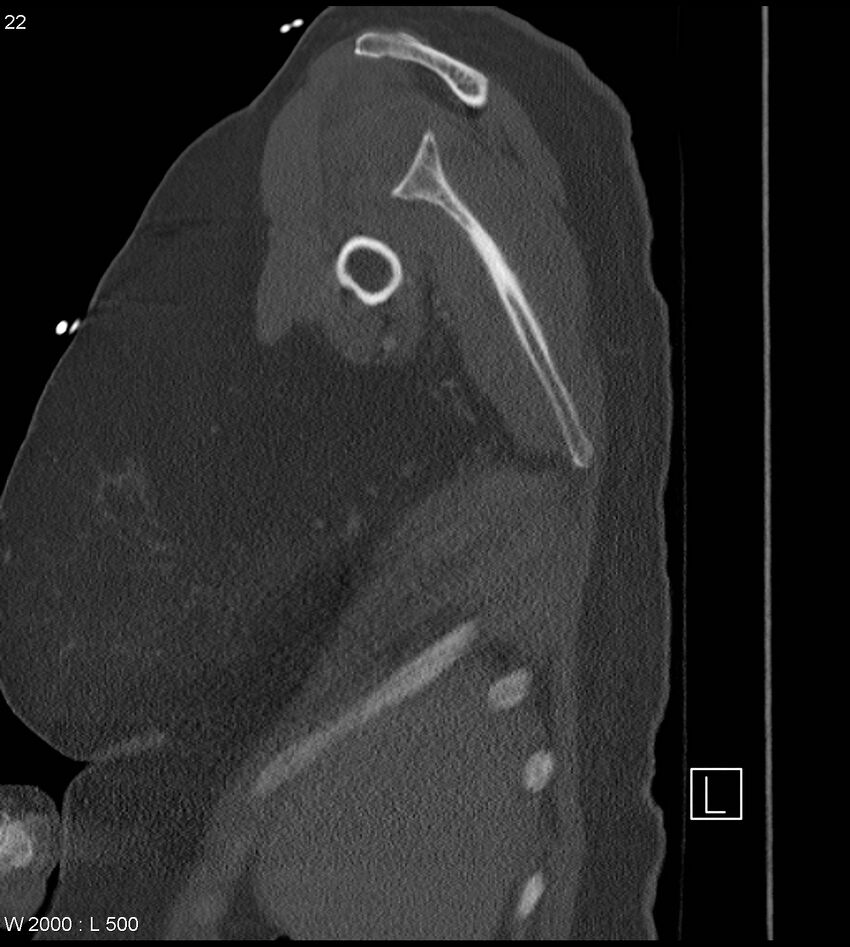 Anterior shoulder dislocation (CT) (Radiopaedia 59032-66309 Sagittal bone window 11).jpg