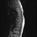 Anterior spinal artery syndrome (Radiopaedia 46335-50750 C 8).png