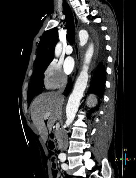 File:Aortic aneurysm and penetrating ulcer (Radiopaedia 23590-23704 C 24).jpg