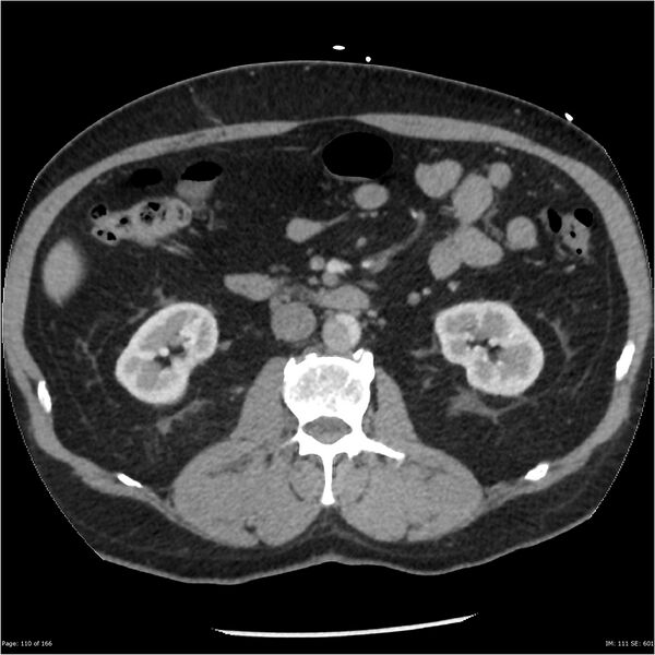 File:Aortic dissection- Stanford A (Radiopaedia 37759-39664 A 101).jpg