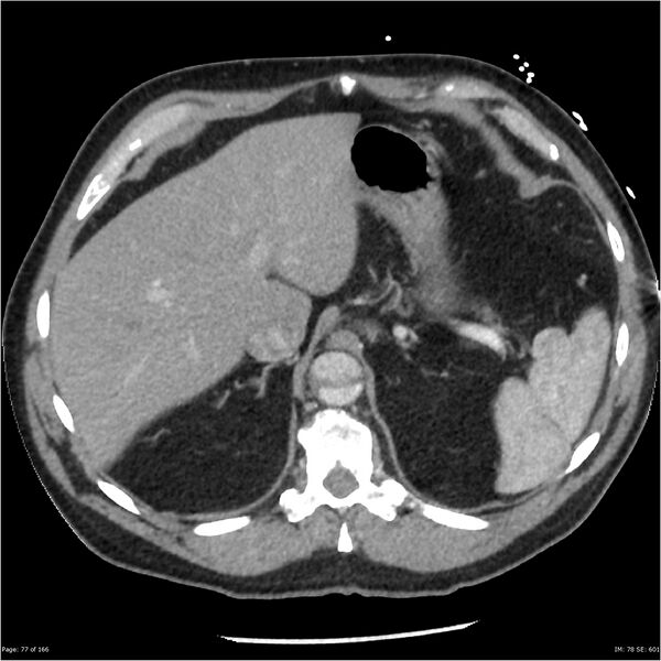 File:Aortic dissection- Stanford A (Radiopaedia 37759-39664 A 68).jpg