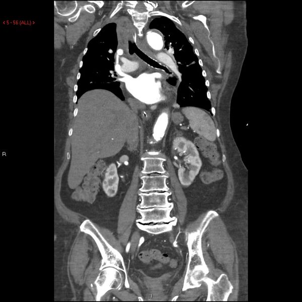 File:Aortic intramural hematoma (Radiopaedia 27746-28001 B 33).jpg