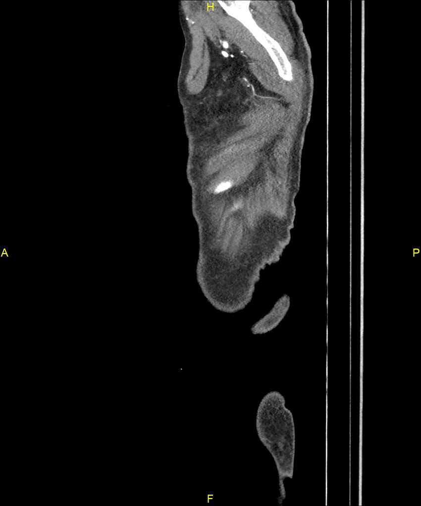 Aortoenteric fistula (Radiopaedia 84308-99603 C 335).jpg