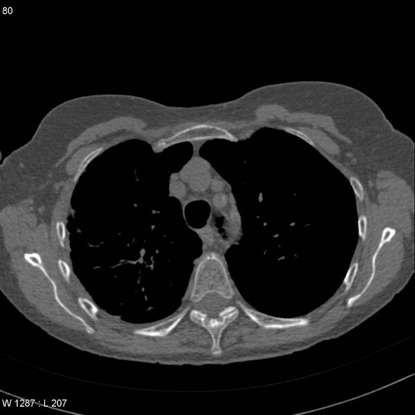 File:Apical non-small-cell lung cancer (Radiopaedia 8570-9405 Axial non-contrast 11).jpg