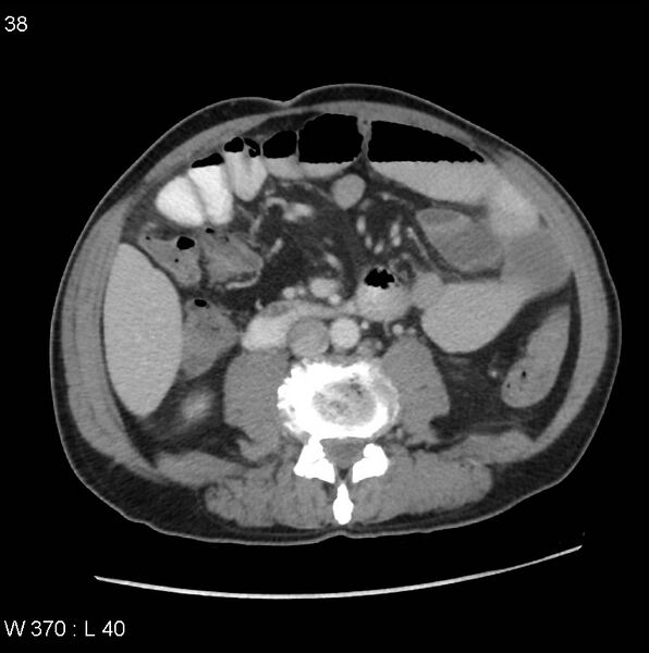 File:Appendicitis (Radiopaedia 27446-27642 A 17).jpg