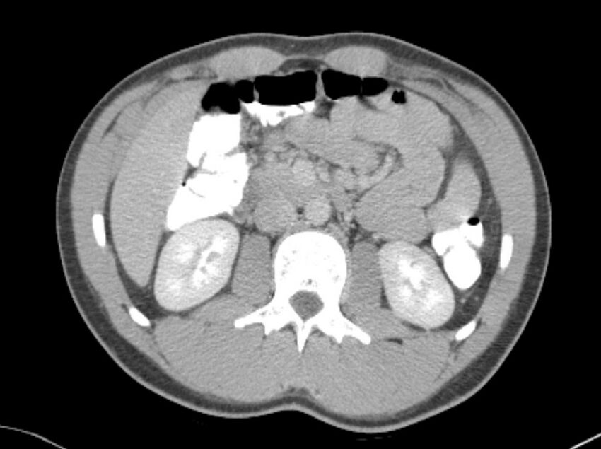 Appendicitis and incidental foregut duplication cyst (Radiopaedia 52962-58916 A 22).jpg