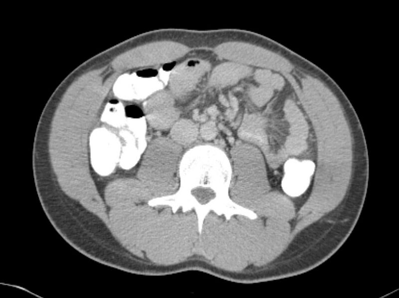 File:Appendicitis and incidental foregut duplication cyst (Radiopaedia 52962-58916 A 34).jpg