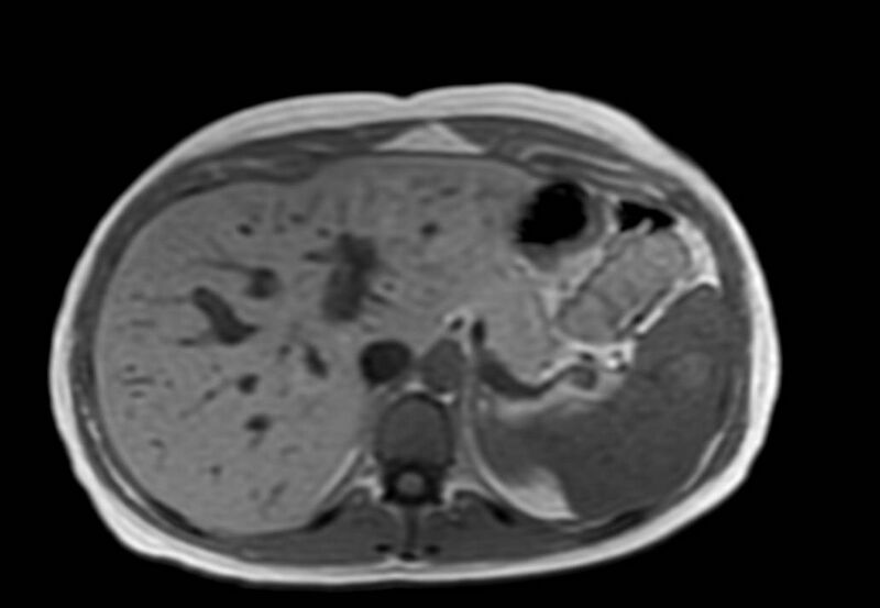 File:Appendicitis in gravida (MRI) (Radiopaedia 89433-106395 Axial T1 in-phase 11).jpg