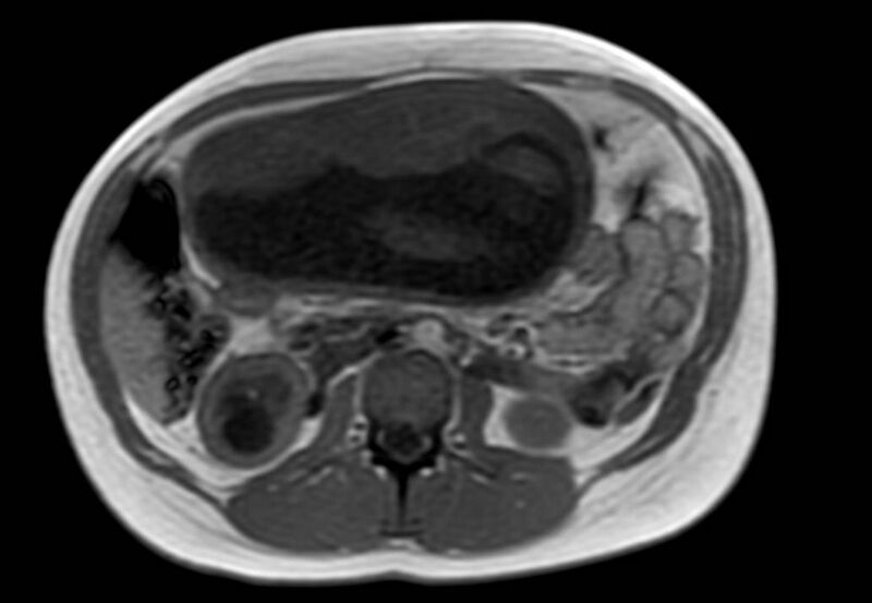File:Appendicitis in gravida (MRI) (Radiopaedia 89433-106395 Axial T1 in-phase 29).jpg