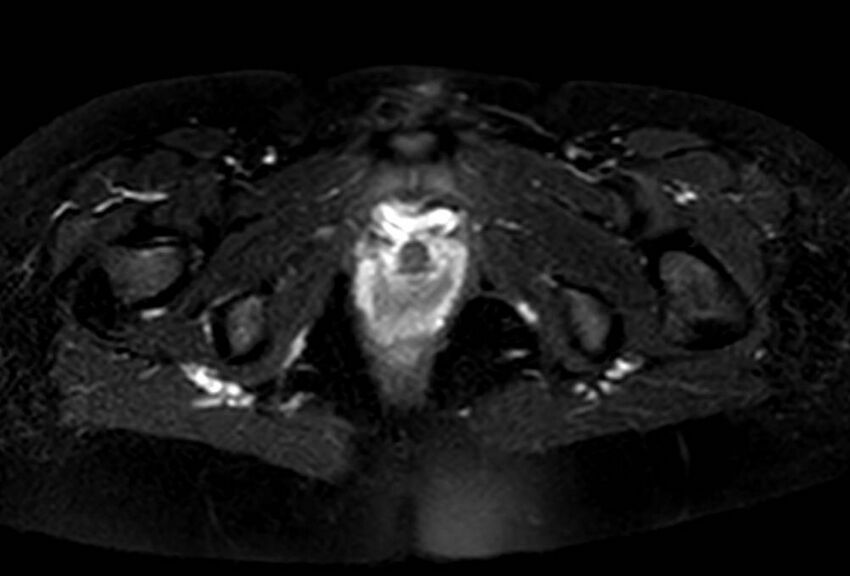 Appendicitis in gravida (MRI) (Radiopaedia 89433-106395 Axial T2 SPAIR 76).jpg