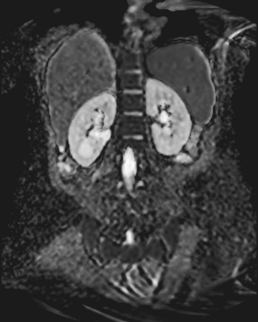Appendicitis in gravida (MRI) (Radiopaedia 89433-106395 Coronal ADC 42).jpg