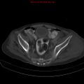Arachnoiditis ossificans (Radiopaedia 51394-57136 Axial bone window 37).jpg