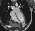 Arrhythmogenic right ventricular cardiomyopathy (Radiopaedia 39806-42237 D 98).jpg