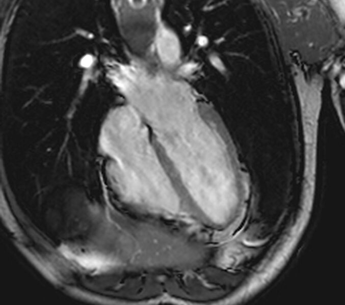 File:Arrhythmogenic right ventricular cardiomyopathy (Radiopaedia 39806-42237 D 98).jpg