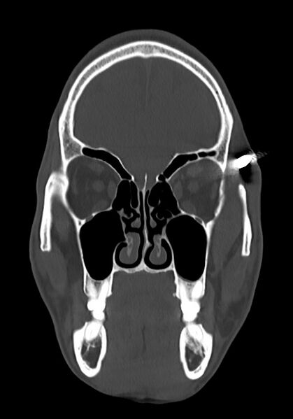 File:Arrow injury to the head (Radiopaedia 75266-86388 Coronal bone window 31).jpg