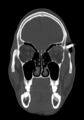 Arrow injury to the head (Radiopaedia 75266-86388 Coronal bone window 31).jpg