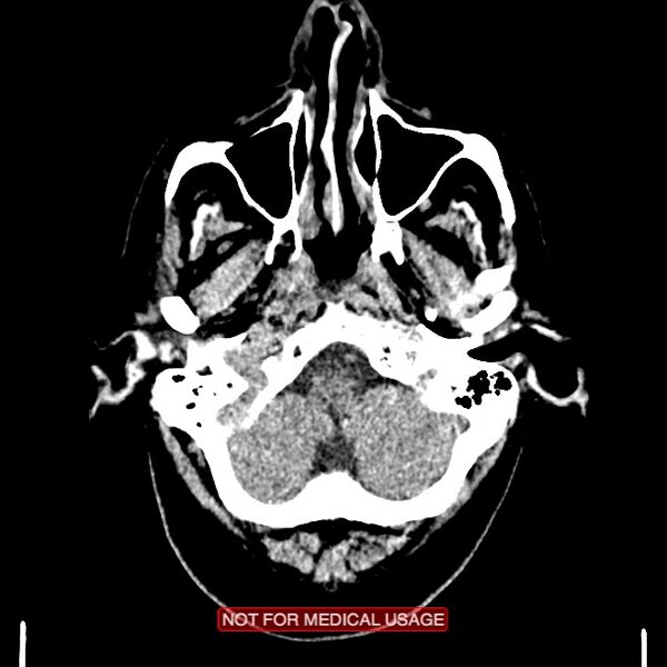 File:Artery of Percheron infarction (Radiopaedia 28679-28967 Axial non-contrast 15).jpg