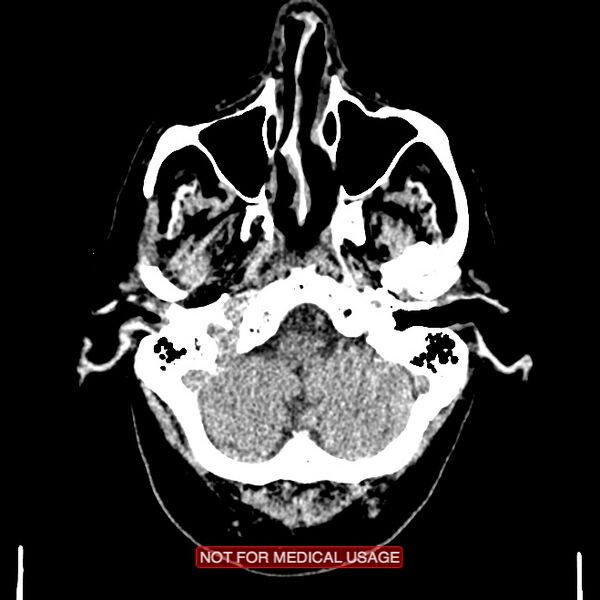 File:Artery of Percheron infarction (Radiopaedia 28679-28967 Axial non-contrast 18).jpg