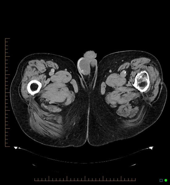 File:Artificial urethral sphincter (Radiopaedia 46937-51464 A 19).jpg