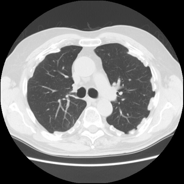 File:Asbestos-related pleural plaques (Radiopaedia 39069-41255 Axial lung window 28).jpg