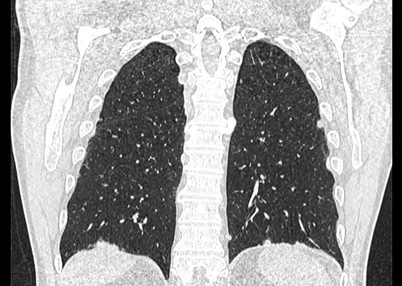 File:Asbestos pleural placques (Radiopaedia 57905-64872 Coronal lung window 228).jpg