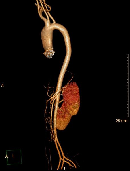 File:Ascending aortic pseudoaneurysm (Radiopaedia 28638-28910 D 26).jpg