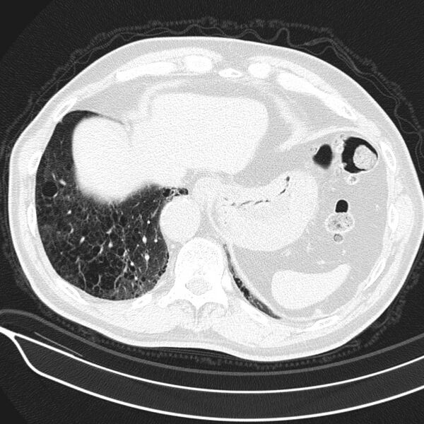File:Aspergilloma (Radiopaedia 24521-24804 Axial lung window 24).jpg