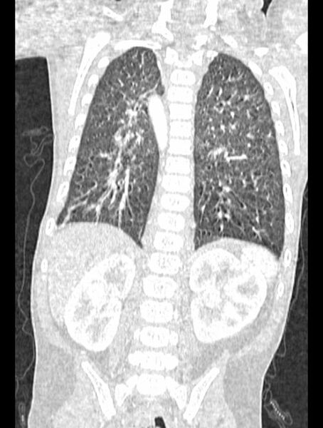 File:Asplenia syndrome (Radiopaedia 73083-83792 Coronal lung window 103).jpg