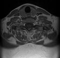 Astrocytoma - spinal cord (Radiopaedia 69769-79758 Axial T1 C+ 16).jpg