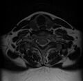 Astrocytoma - spinal cord (Radiopaedia 69769-79758 Axial T2 17).jpg
