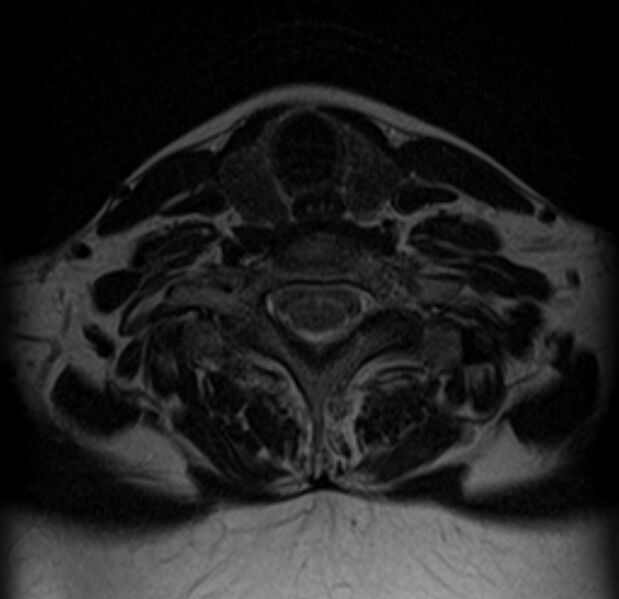 File:Astrocytoma - spinal cord (Radiopaedia 69769-79758 Axial T2 17).jpg