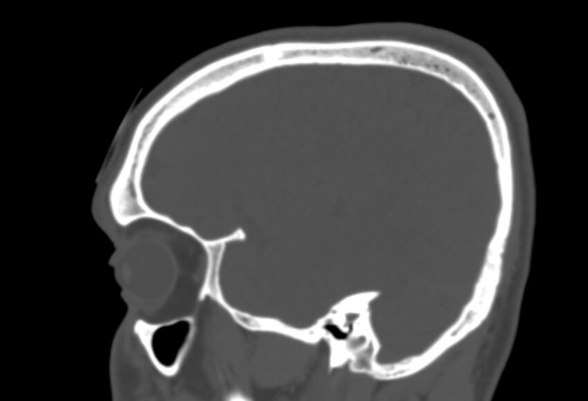 Asymptomatic occipital spur (Radiopaedia 87753-104201 Sagittal bone window 69).jpg