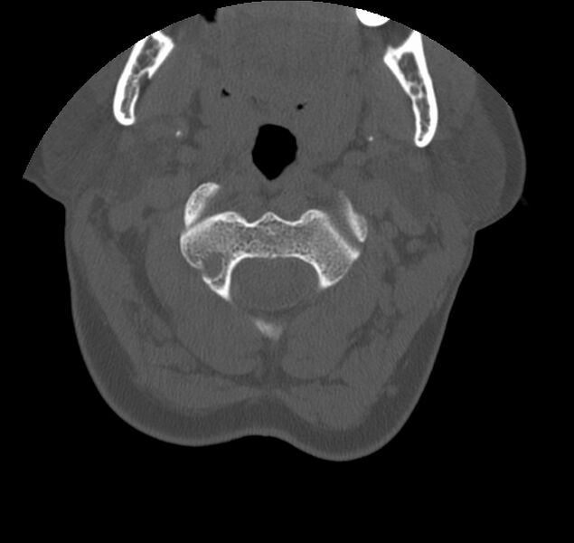 File:Atlanto-occipital assimilation with basilar invagination (Radiopaedia 70122-80188 Axial bone window 34).jpg